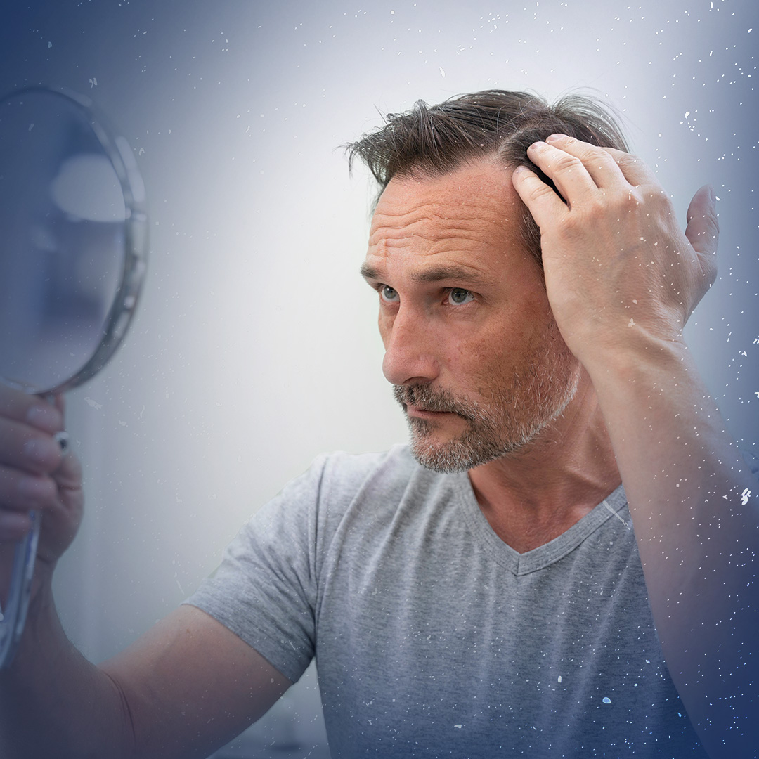 Testosterona não causa queda de cabelo em todo mundo.